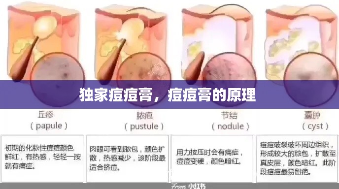 独家痘痘膏，痘痘膏的原理 