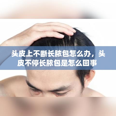 头皮上不断长脓包怎么办，头皮不停长脓包是怎么回事 