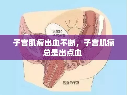 子宫肌瘤出血不断，子宫肌瘤总是出点血 