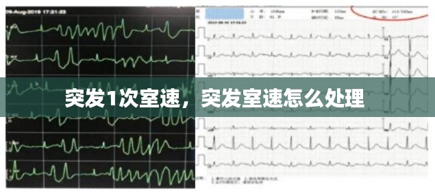 突发1次室速，突发室速怎么处理 