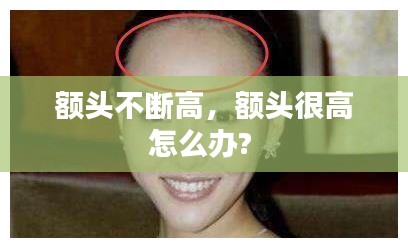 额头不断高，额头很高怎么办? 