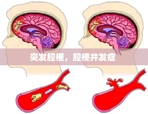 突发腔梗，腔梗并发症 